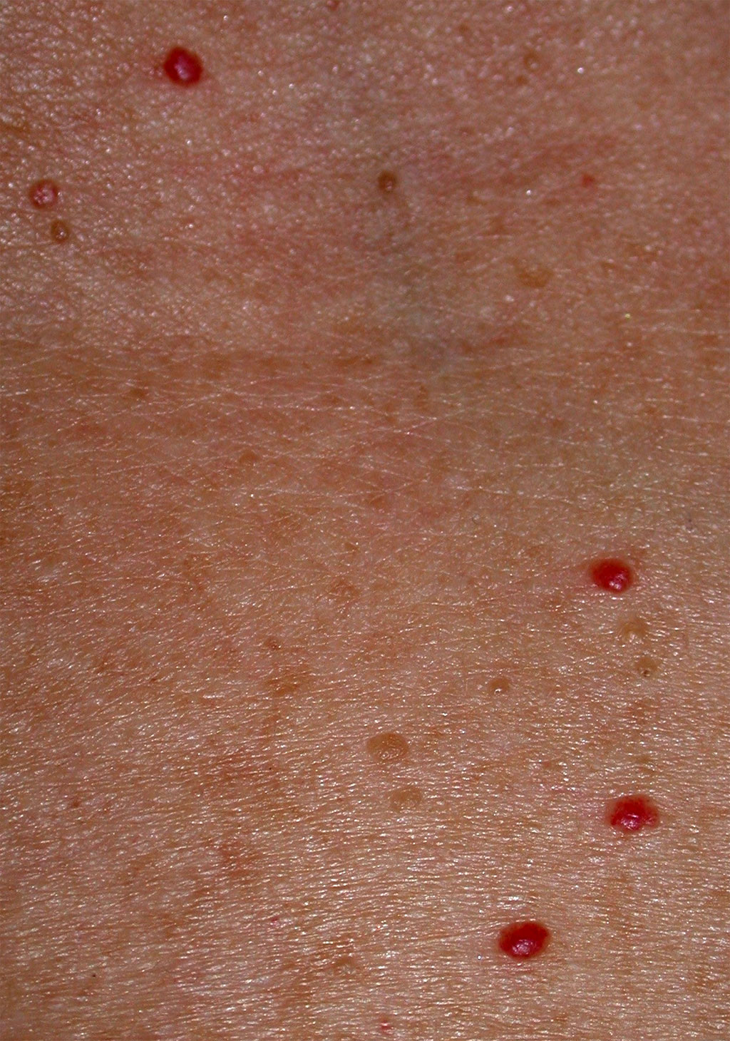 Sudden tiny bumps on face - Skin Problems Message Board ...