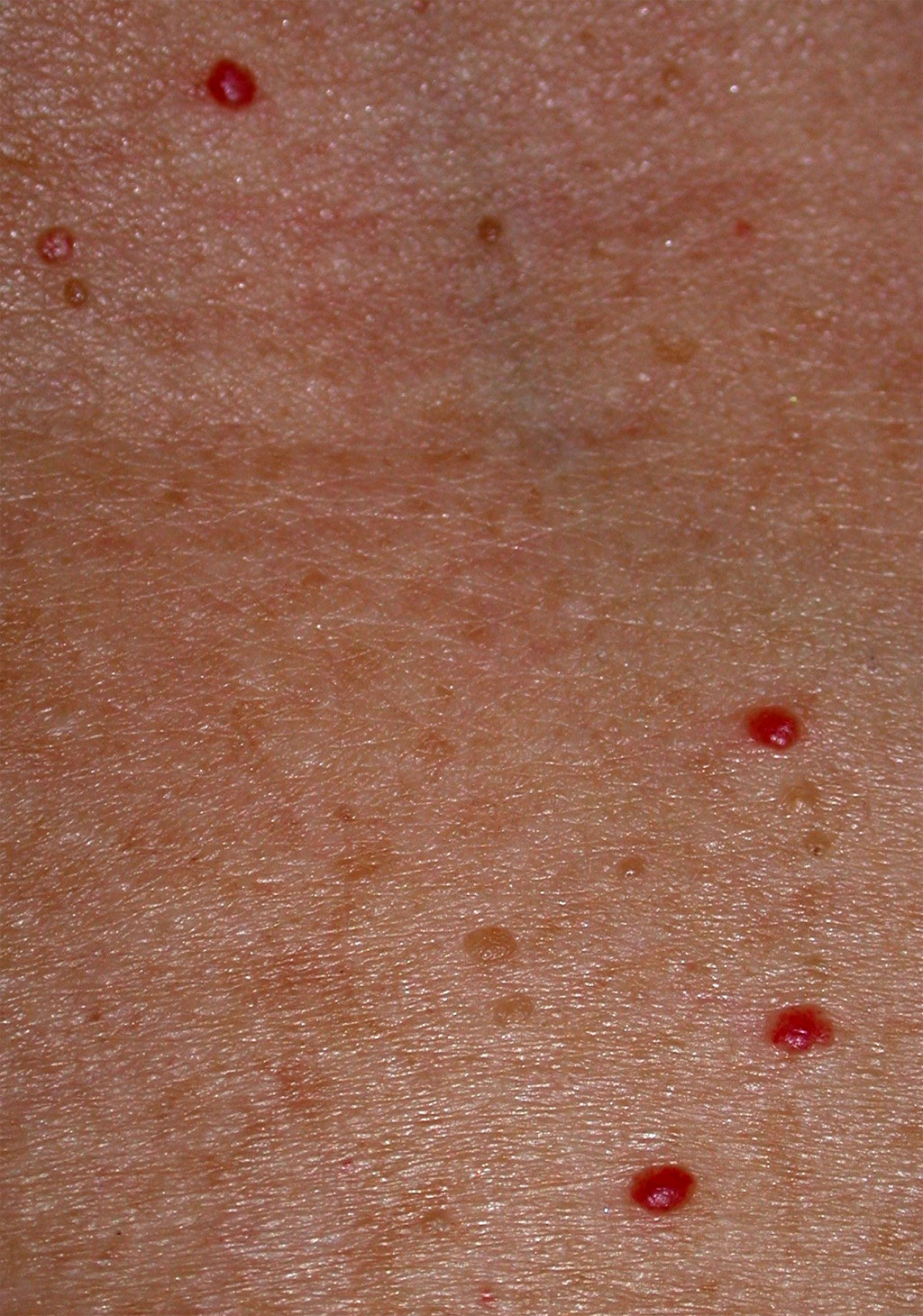 Red Itchy Bumps On My Stomach - Skin Forum - eHealthForum