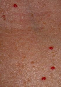 Dermatology Red Spot Doctor Answers, Q&A, Tips - RealSelf