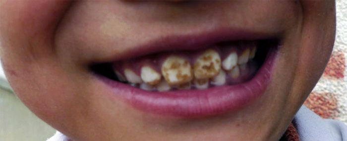 fluorosis example