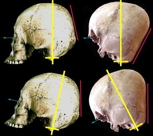 Human cradleboarded skull and Starchild Skull