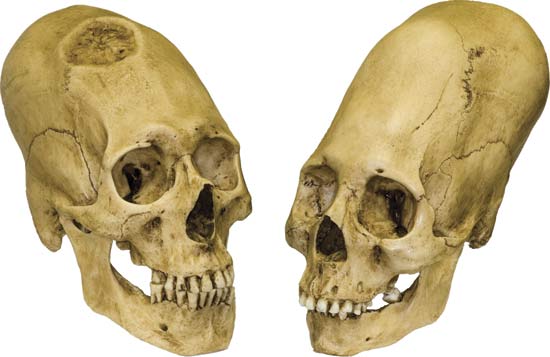 Peruvian elongated skulls: examples of artificial cranial modification