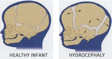 Expansion of sutures in hydrocephalic child