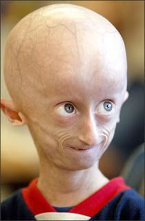 Child suffering from progeria.