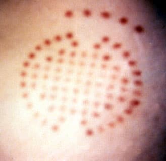 Abductee’s complex pattern mark.