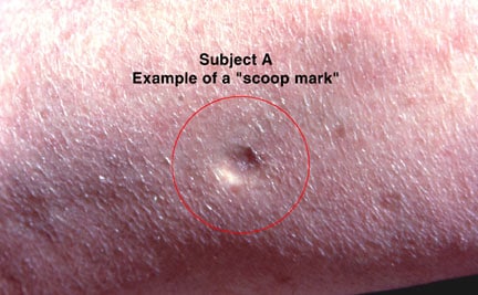 ‘Scoop mark’ thought to be like punch biopsy scar.