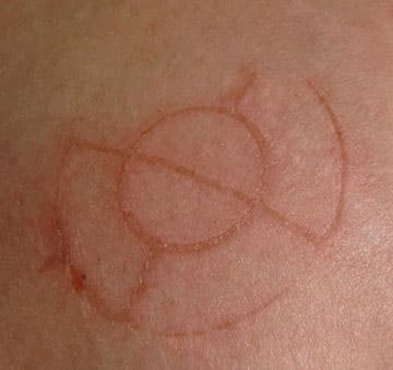 Abductee’s target-like mark.