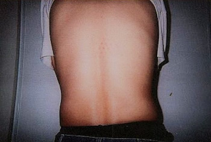 Triangular markings on Saebels' son's back