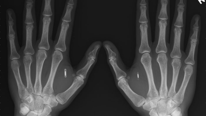 A X-ray of a pair of hands with an implant in them