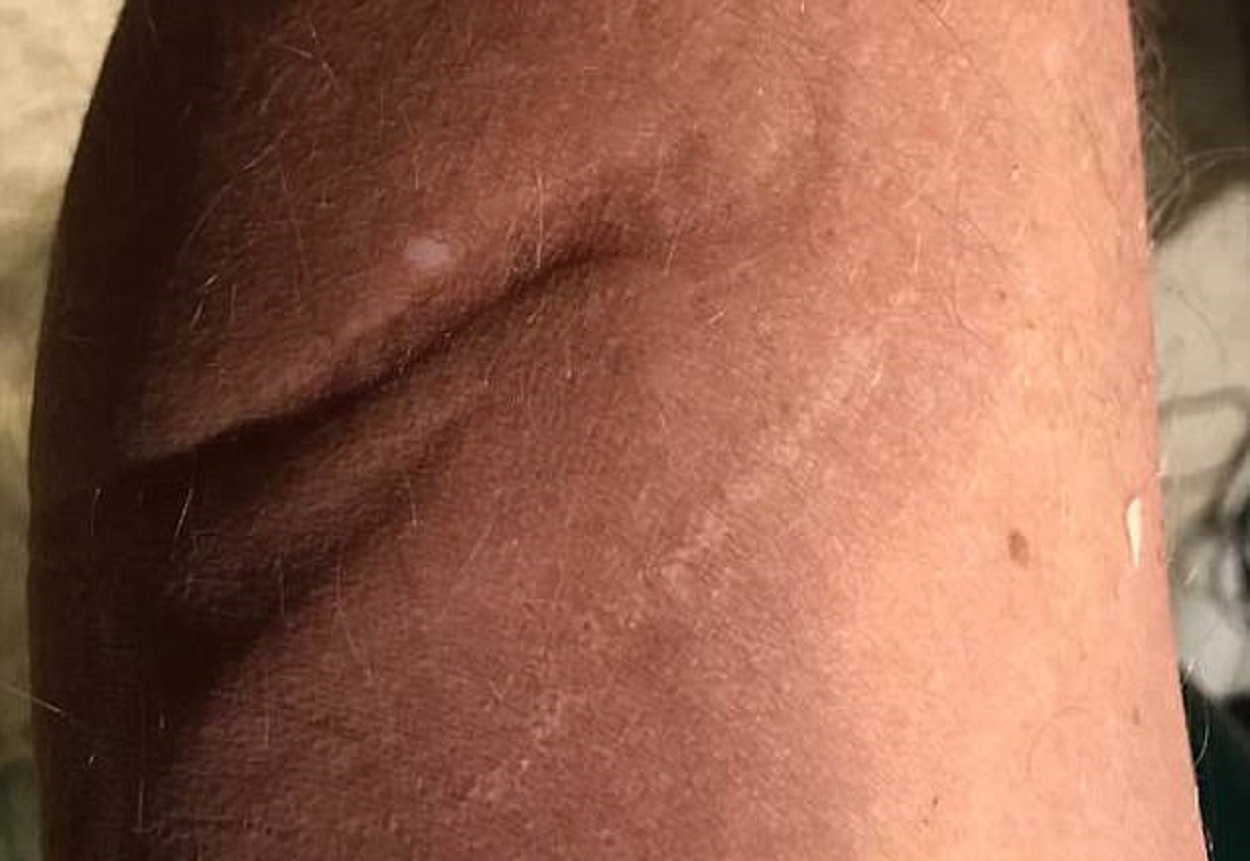 A scar Edmonds claimed he received from an alien device